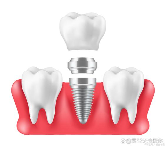 右下颌骨全切除能植牙吗-图2