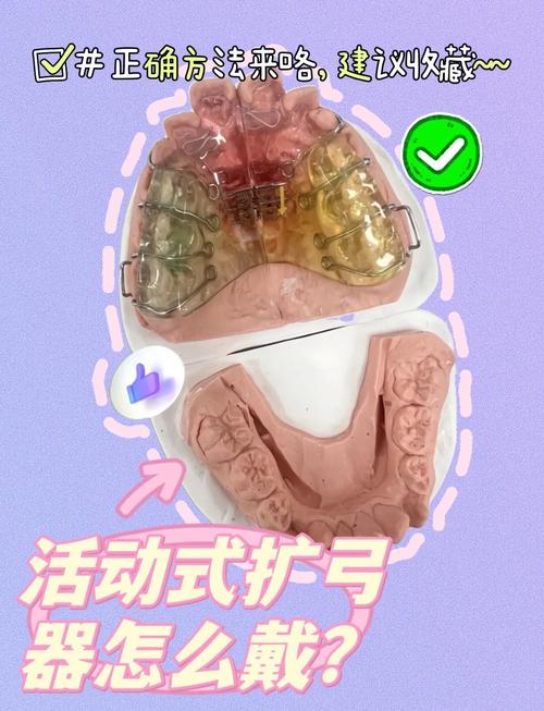 口腔正畸口外弓怎么戴？正确佩戴方法步骤有哪些？-图3