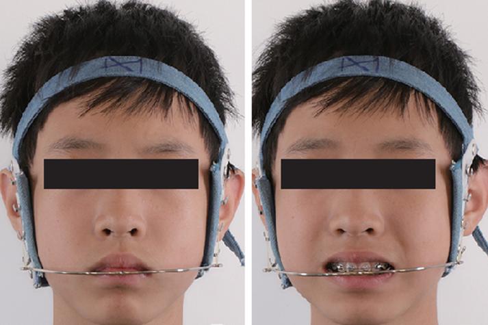 口腔正畸口外弓怎么戴？正确佩戴方法步骤有哪些？-图1