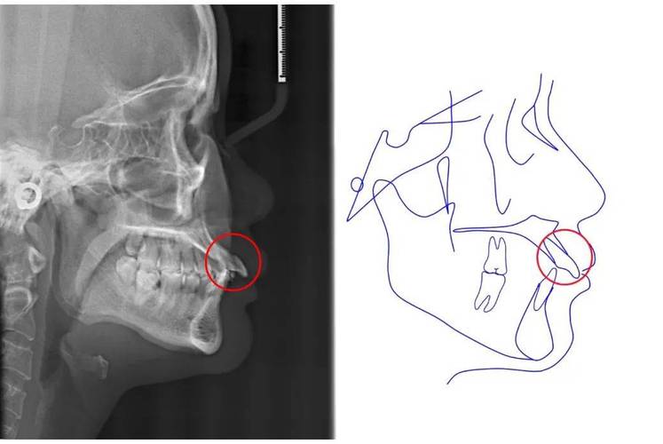 正畸中髁突位置靠前-图1