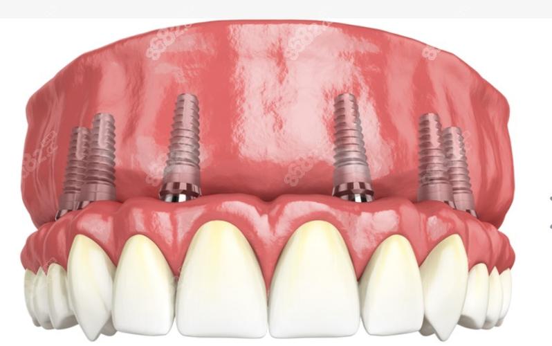 厦门allon6种植牙效果如何？优势有哪些？价格怎么样？-图2