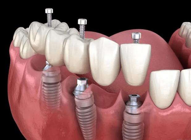 上颚植牙手术视频全过程-图2