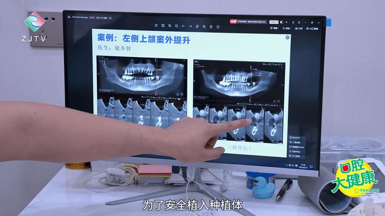 上颚植牙手术视频全过程-图1