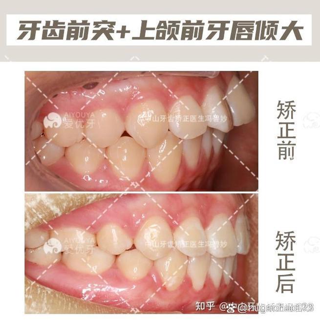 中山牙齿正畸哪家好？选机构该看重口碑、技术还是效果？-图1