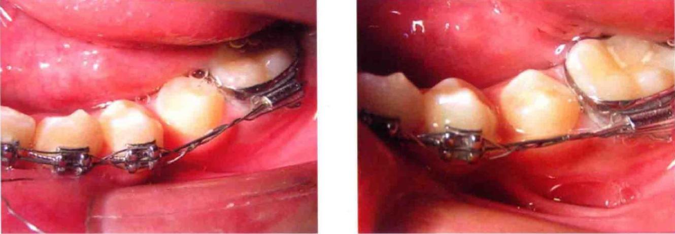 正畸结扎丝对折结扎-图1 正畸结扎丝对折结扎-图1