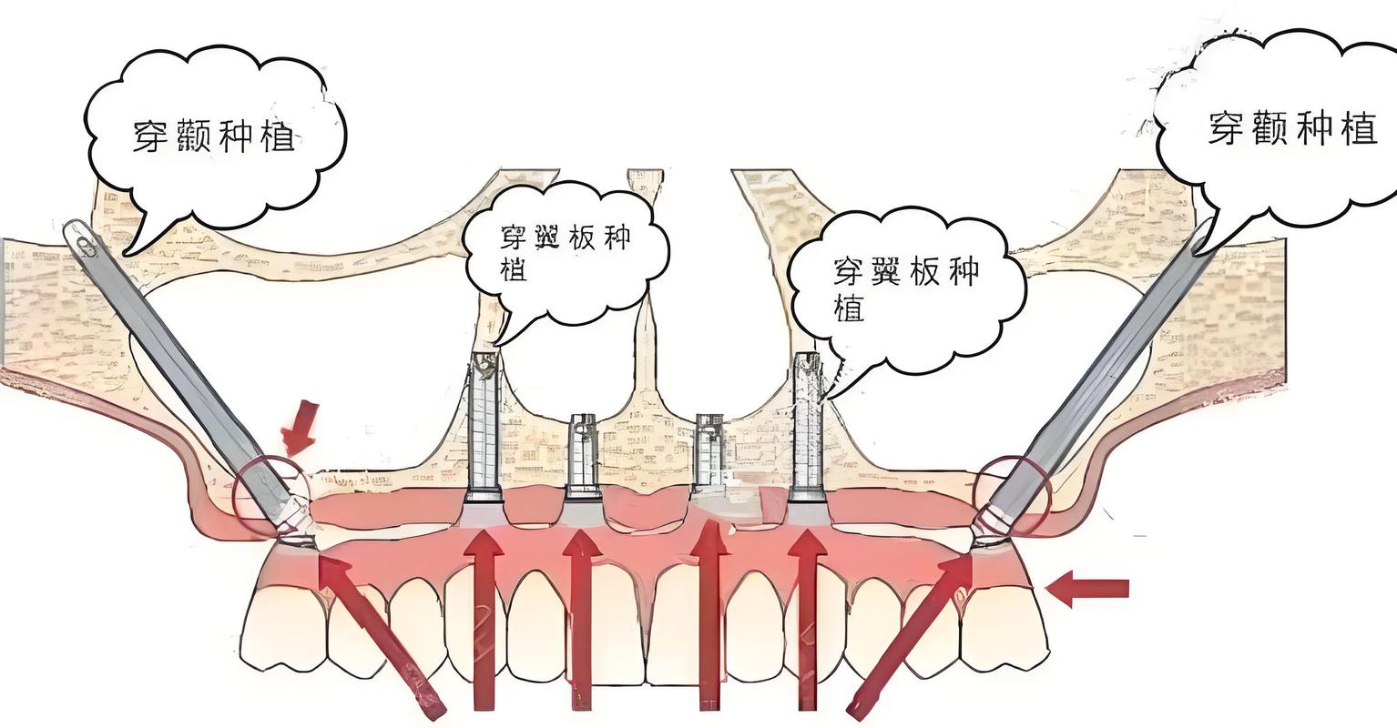需要植骨种牙的手术步骤-图1