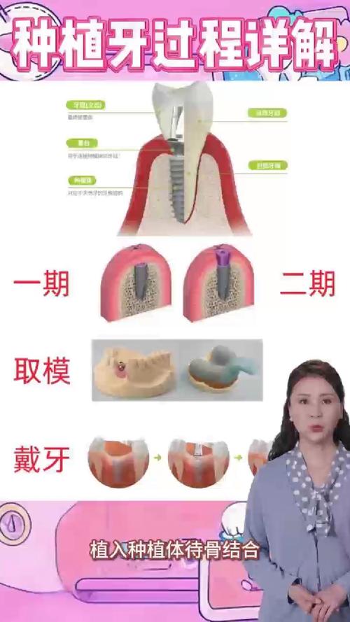 需要植骨种牙的手术步骤-图2