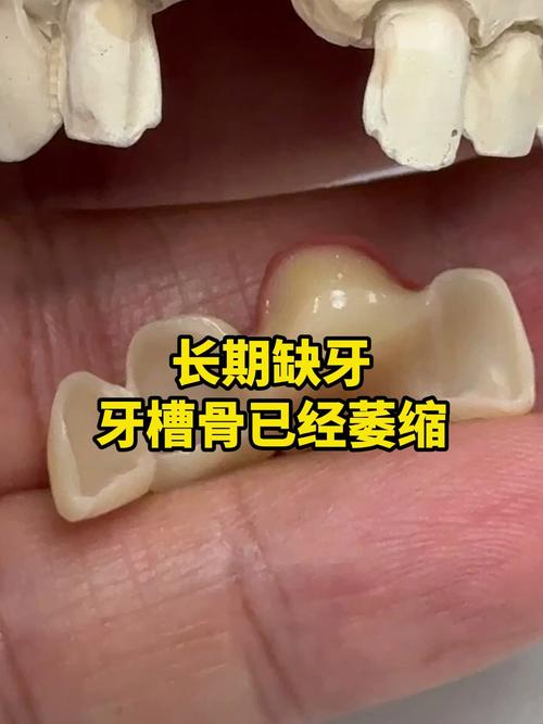 牙槽骨萎缩严重不能植骨-图3