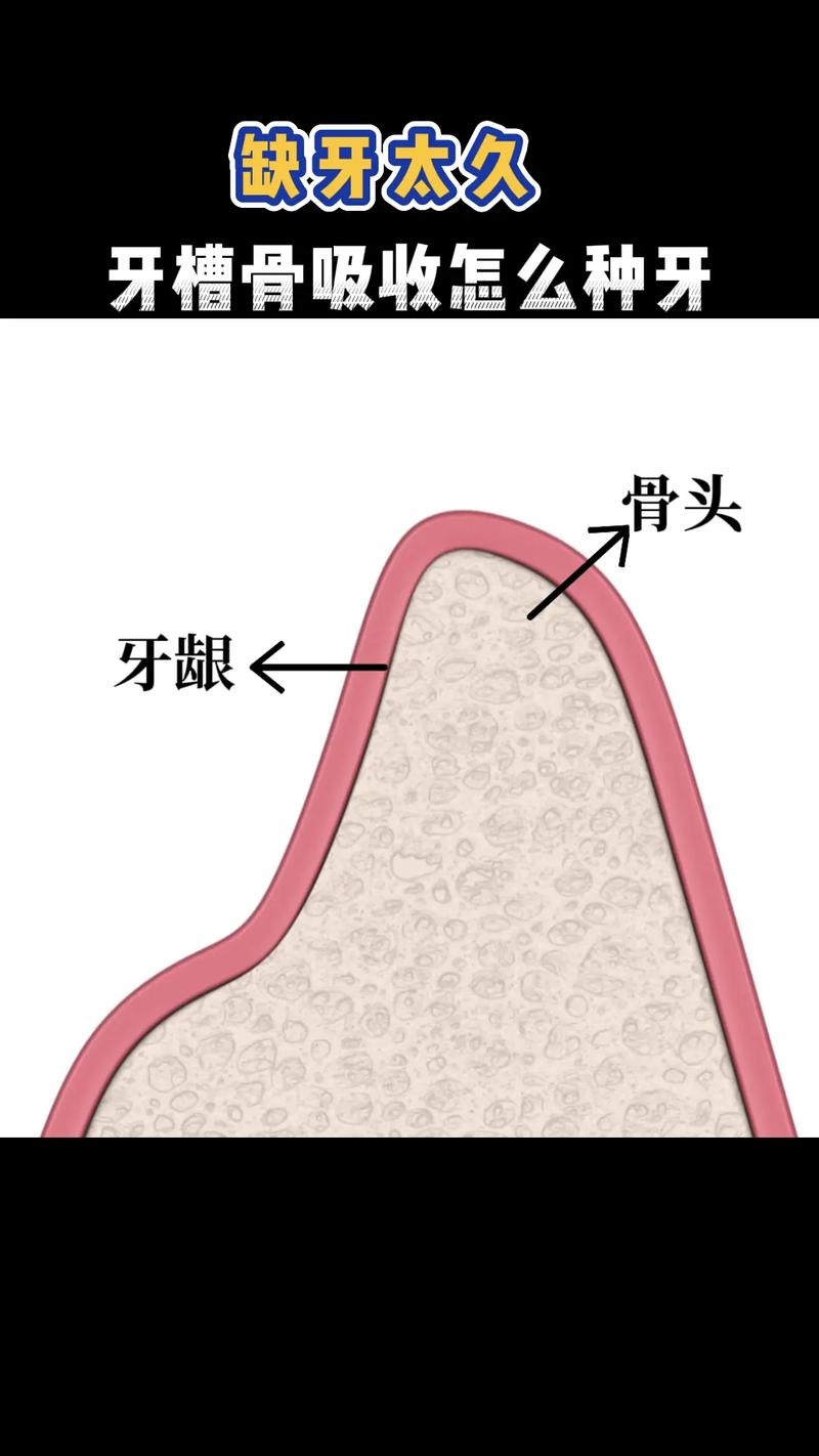 牙槽骨萎缩严重不能植骨-图2