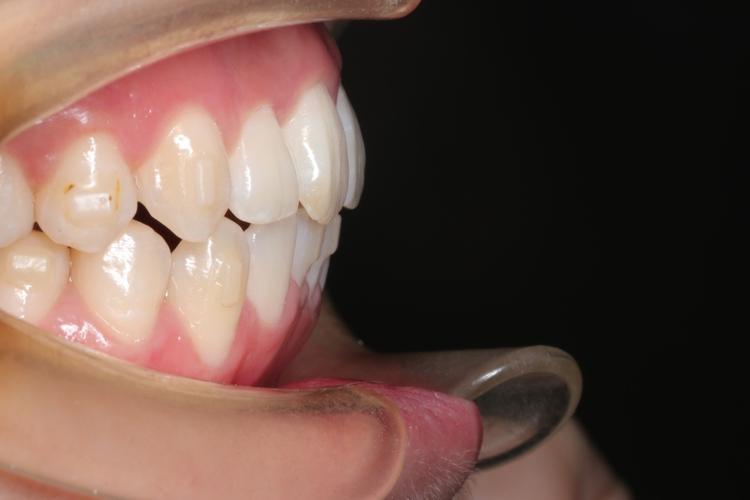 口腔正畸摄影45度-图1