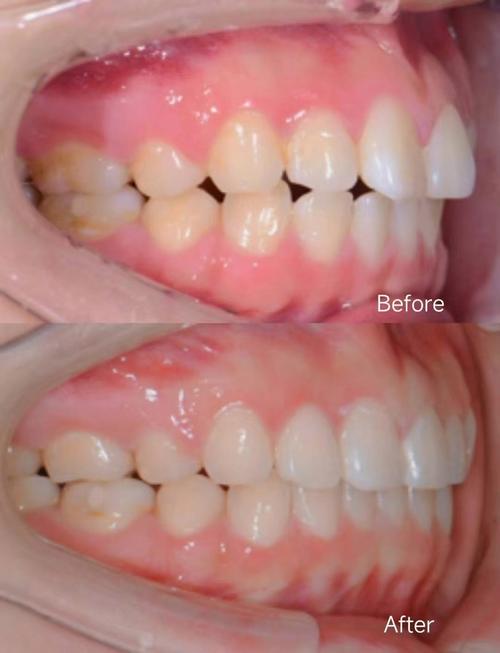 口腔正畸摄影45度-图2