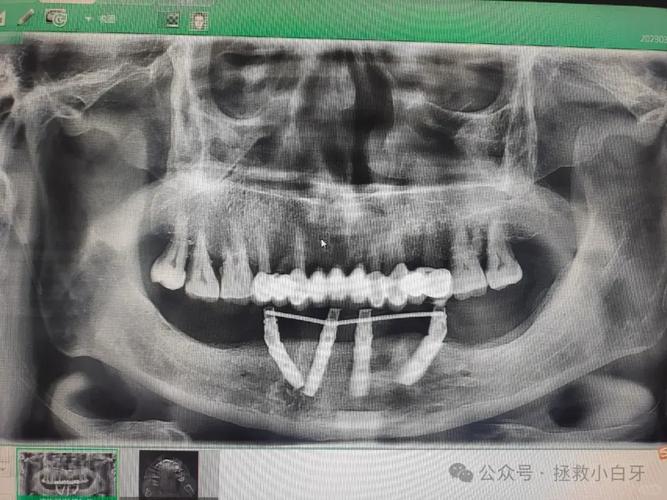 allon4种植牙需要满足哪些条件？-图1
