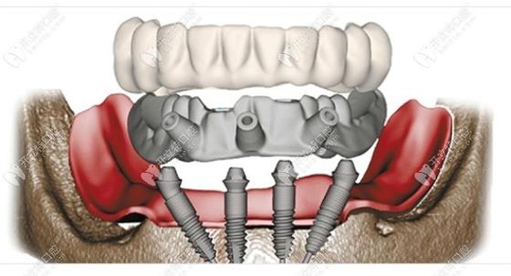 allon4种植牙需要满足哪些条件？-图2