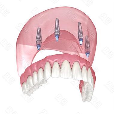 allon4种植牙需要满足哪些条件？-图3