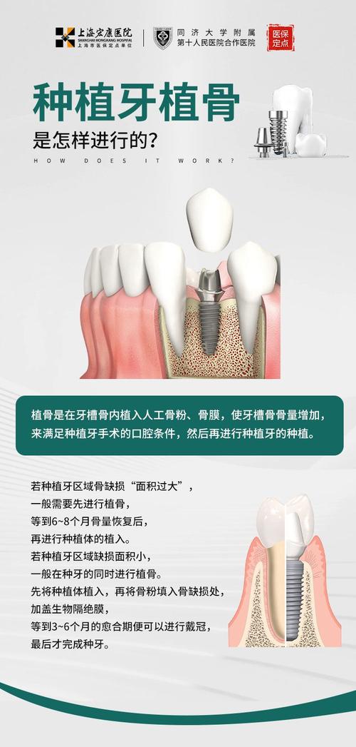 植骨种牙后多久可以恢复-图2