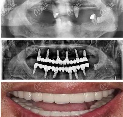 allon4种植牙图片-图3