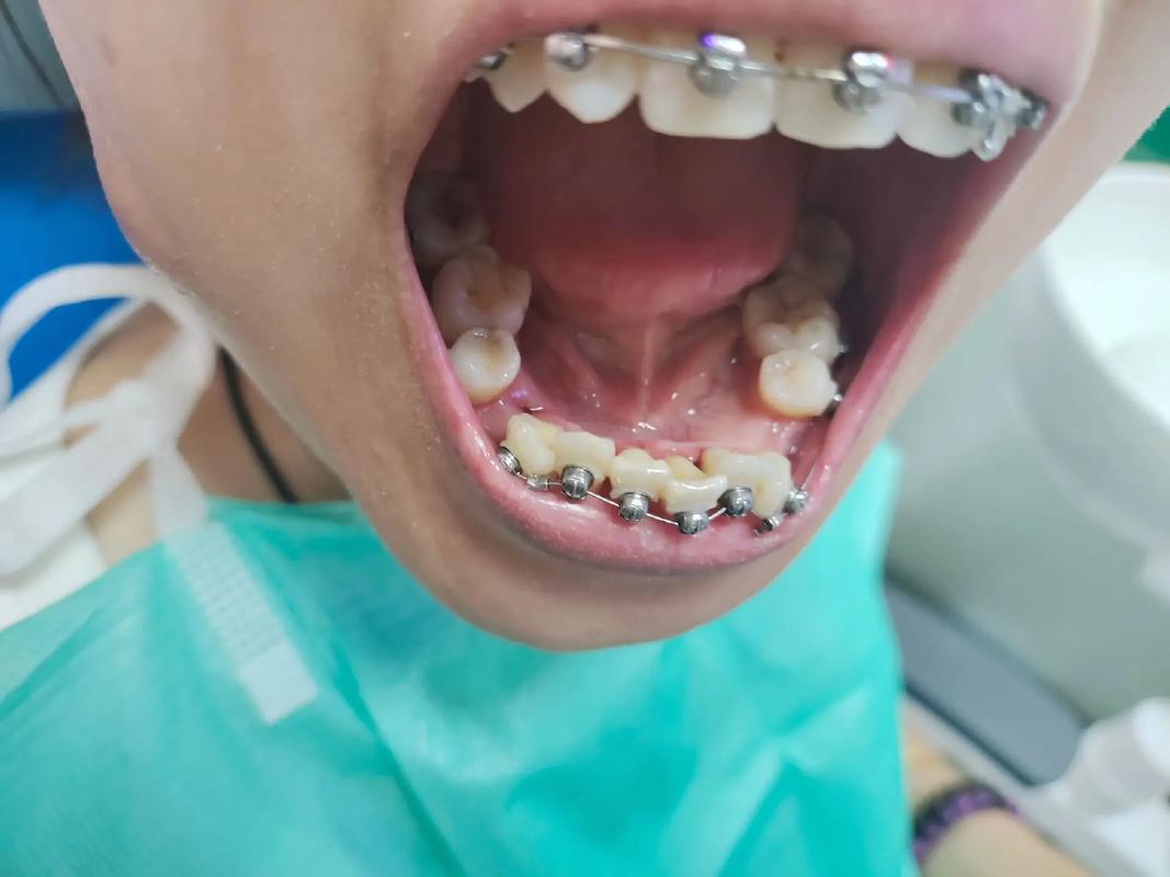 正畸托槽什么牌子好-图2