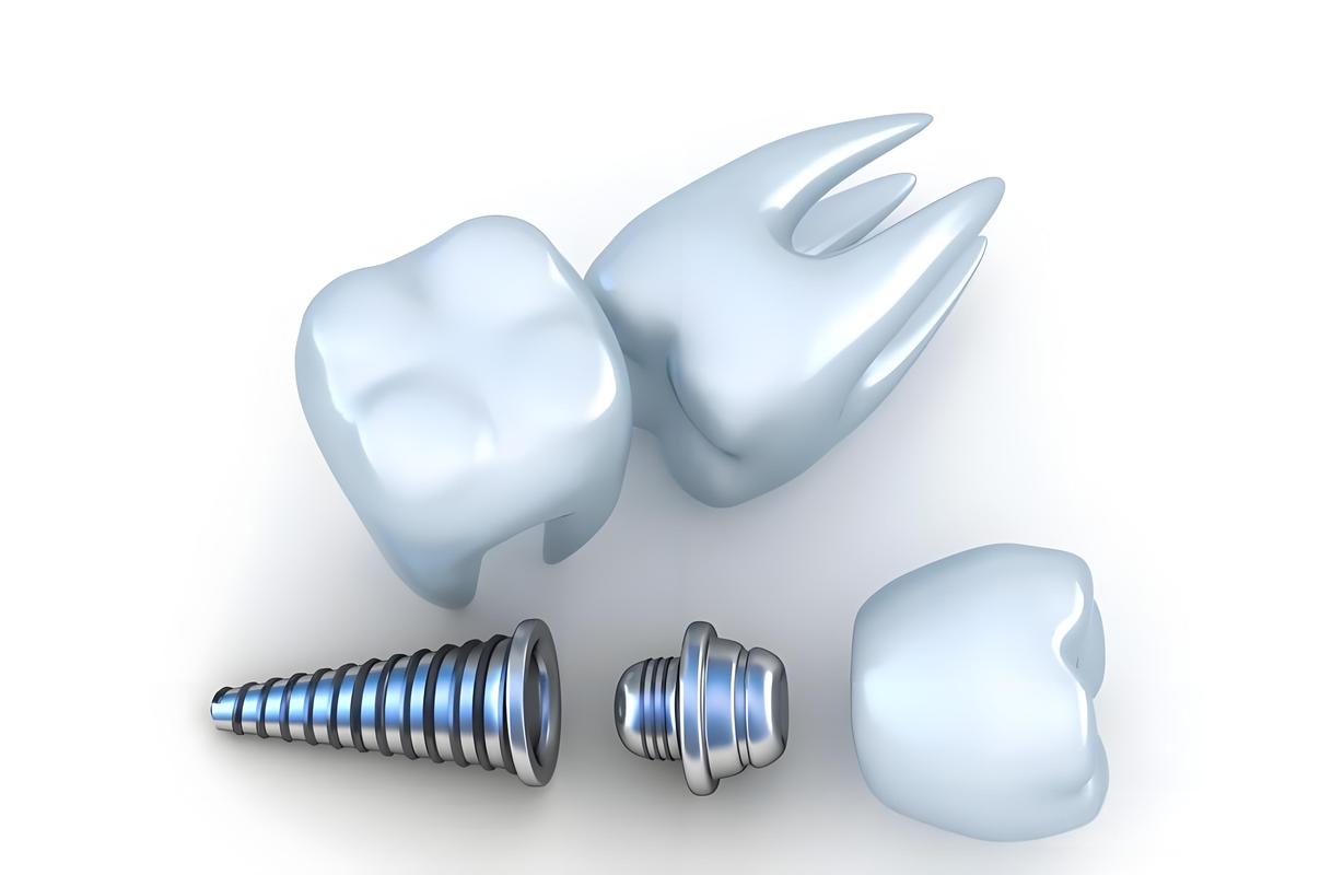 即刻负重种植牙用的植体为何能实现即刻负重？-图1