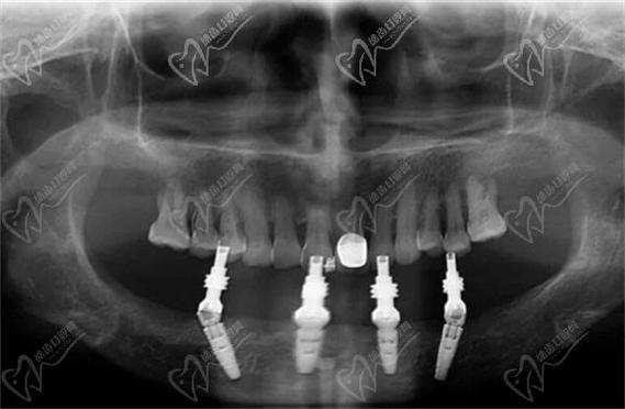 all-on-4植牙图包含哪些种植流程、技术要点及效果信息？-图3