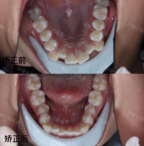 天坛口腔医院正畸效果如何？医生靠谱吗？-图3