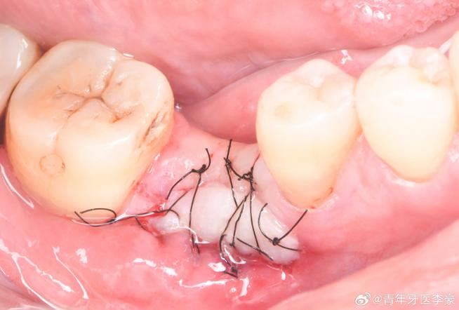 植牙骨粉掉出来了该怎么办？-图2