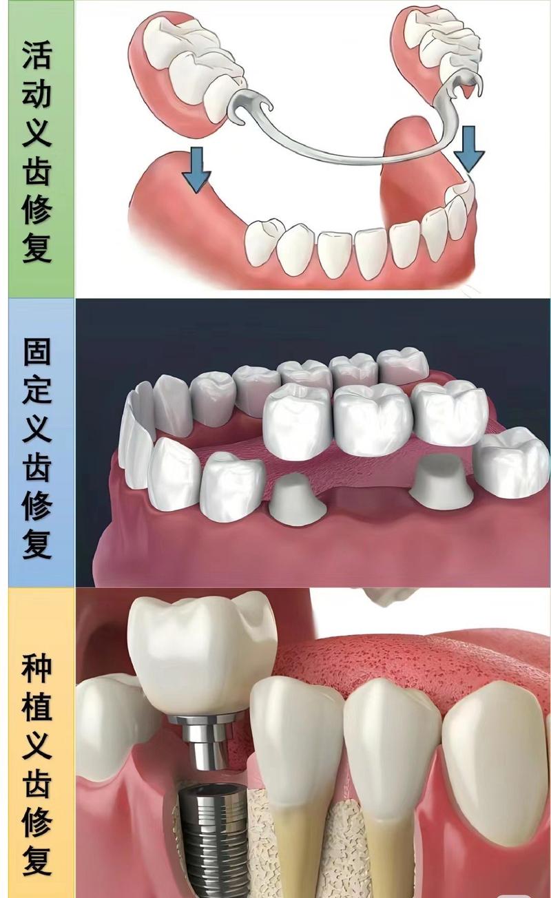 牙齿断了半截 能植牙吗-图1