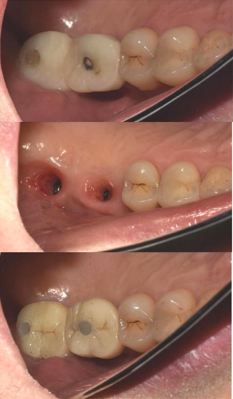 植牙或安装牙冠后牙齿痛，究竟是什么原因导致的呢？-图2