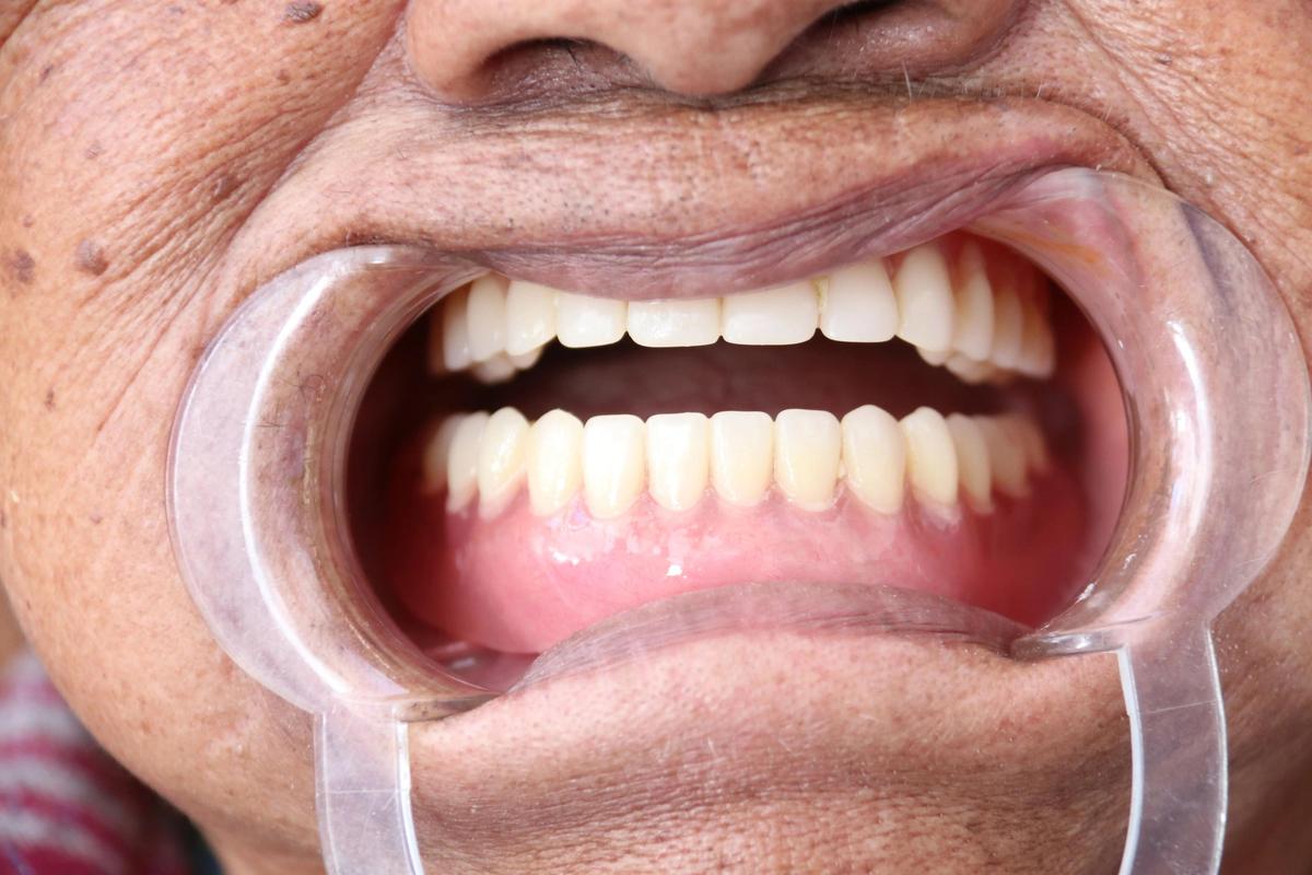 中老年植牙一般指的是哪些牙齿？-图3