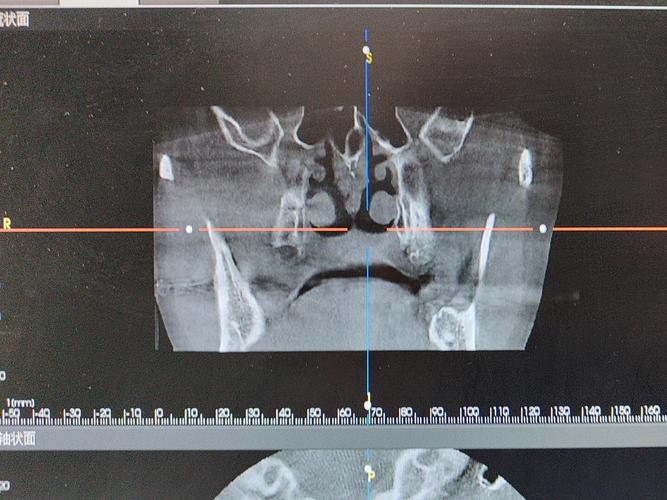 德国植牙ICX系统怎么样？效果与优势如何？-图2
