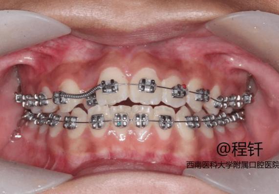 下颌前牙骨增量正畸-图2