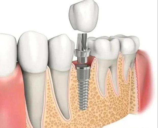 牙植体可以放在牙骨里吗-图2