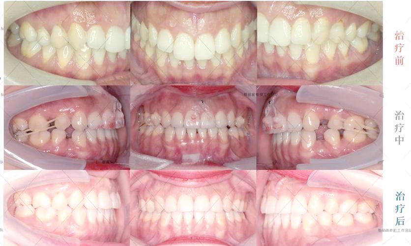 正畸生理性支抗技术相较于传统支抗有何独特优势？-图3