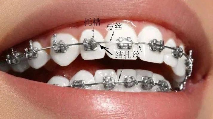 正畸托槽粘贴方法的关键步骤有哪些？-图3