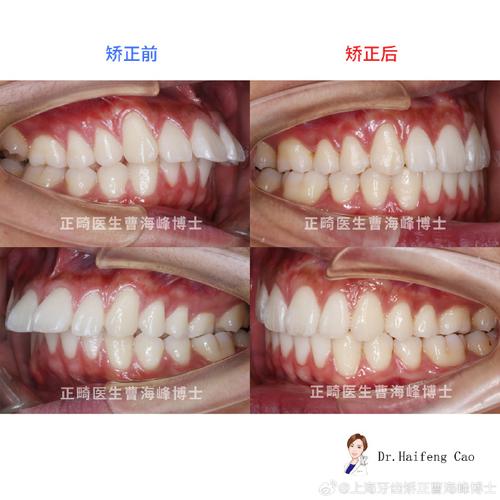上海牙齿正畸哪家好？靠谱机构怎么选？-图3