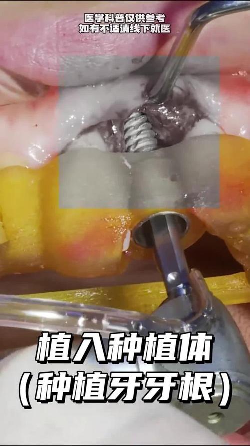 牙根一直都在能植牙吗-图1