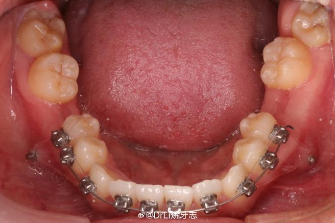 正畸 牵引沟是什么-图2