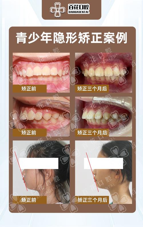 隐形正畸对脸型改变-图1