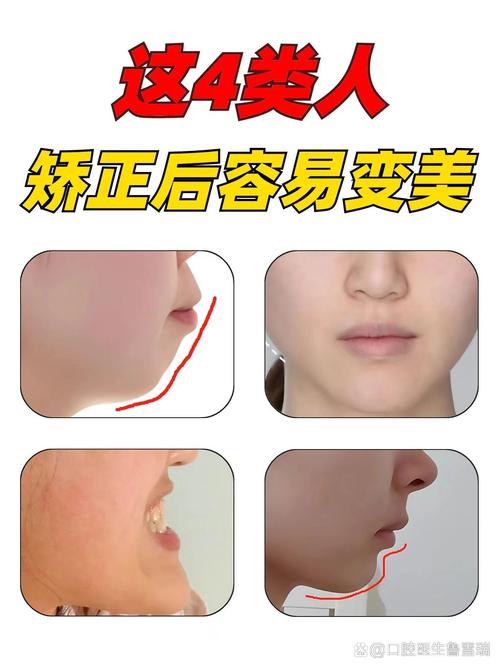 隐形正畸对脸型改变-图2