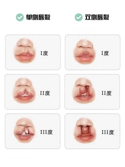 腭裂患者能做正畸治疗吗？-图3