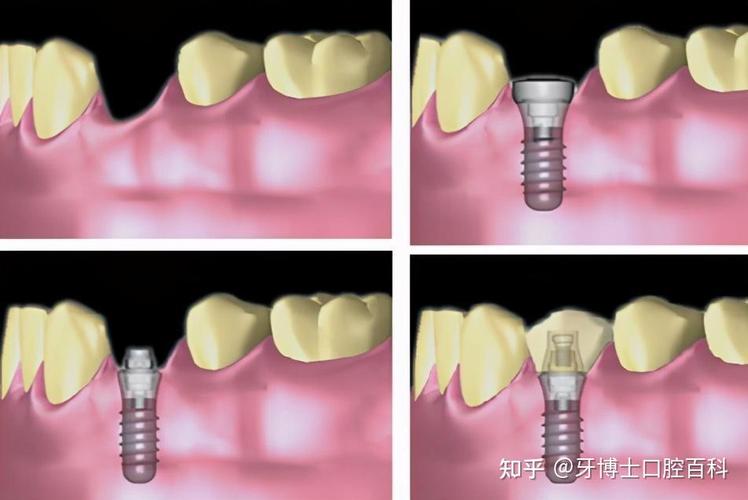 广东省口腔医院種植牙-图2