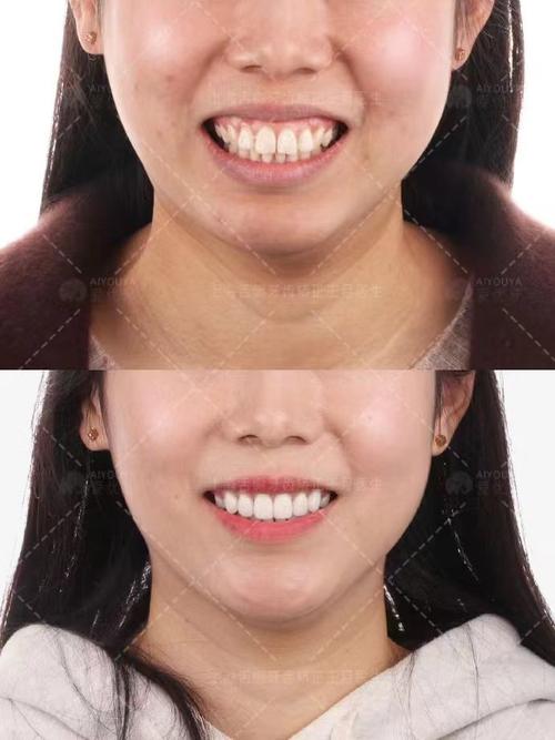 上海去哪里牙齿正畸-图2 上海去哪里牙齿正畸-图2