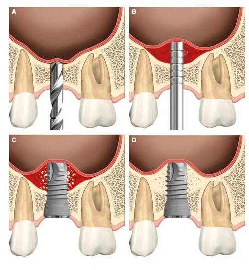 种牙植骨后是否还需额外打钉？关键步骤解析-图2