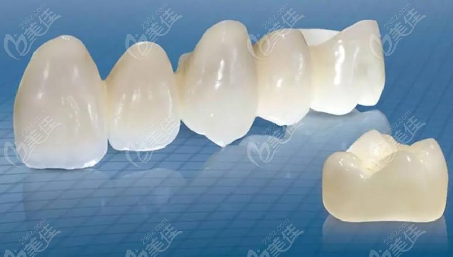 美国3i植体系统种牙效果如何？有哪些优势？适合哪些人？-图2