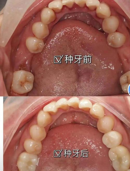 植牙后 看不见种植体-图3