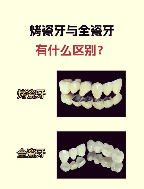 重植牙和烤瓷牙哪个好？选哪个更合适？-图3