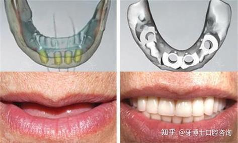 301种植牙成功率高-图2