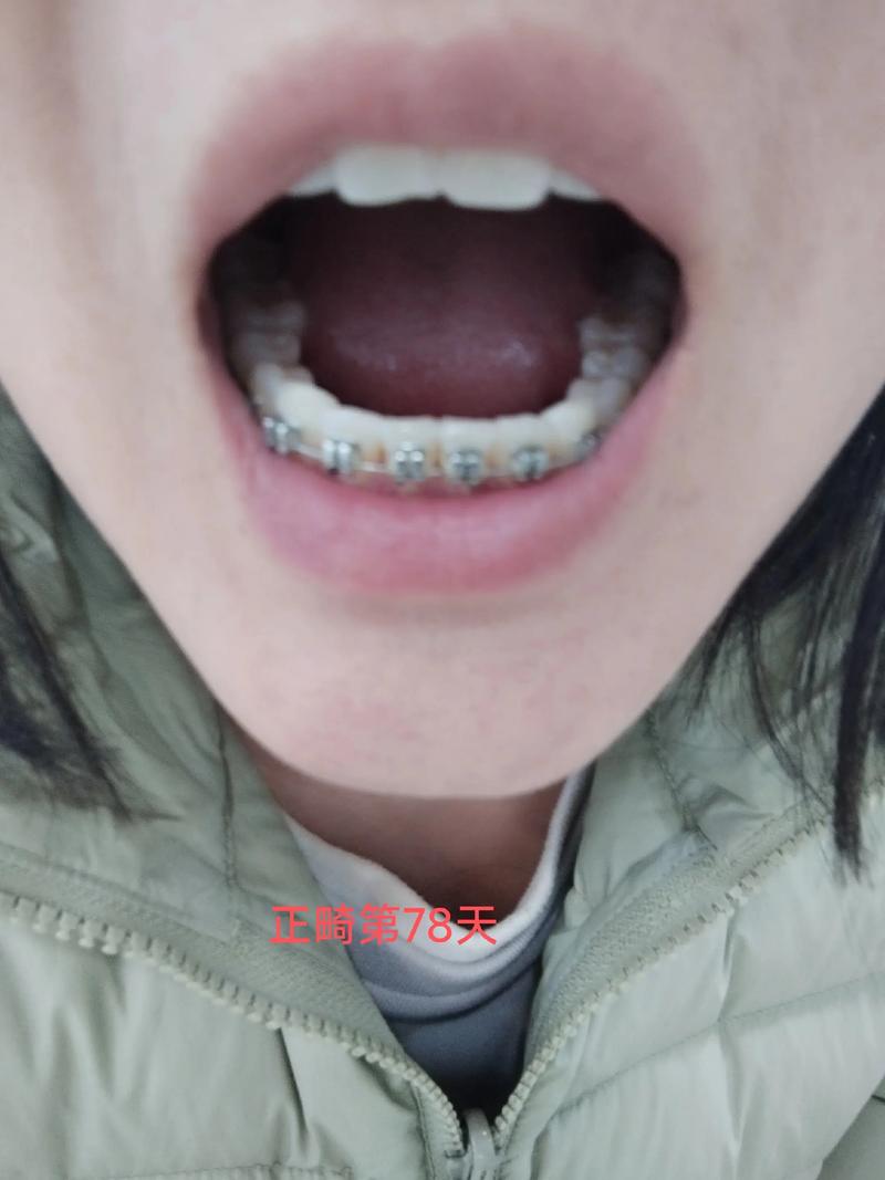 燕郊儿童医院正畸效果如何？几岁孩子适合做？-图2