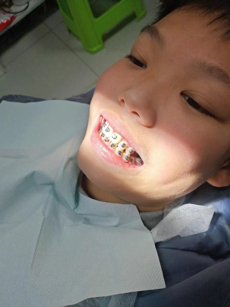 燕郊儿童医院正畸效果如何？几岁孩子适合做？-图3