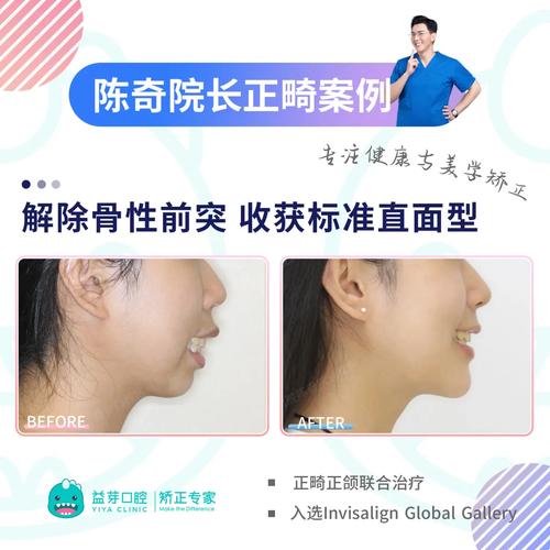 正颌-正畸联合诊治-图2