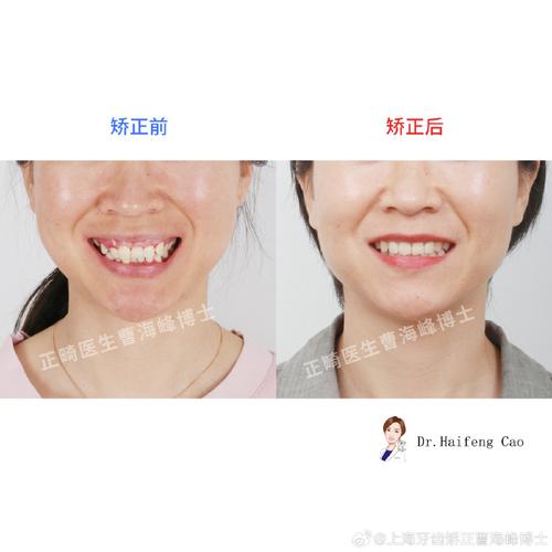 正颌-正畸联合诊治-图3